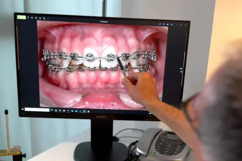 Primo piano di un monitor che mostra un'immagine ravvicinata di denti con apparecchio fisso. Una mano indica l'immagine.
