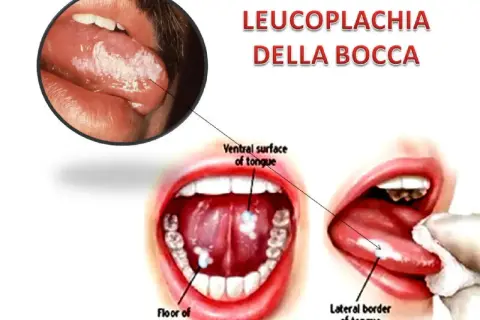 Leucoplachia della bocca: lesioni biancastre su lingua e pavimento orale. Non è una malattia che porta alla morte, ma un segnale da non sottovalutare.
