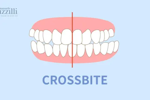 Illustrazione di un morso testa a testa, dove i denti superiori coprono quelli inferiori. Il termine "CROSSBITE" è scritto in basso.