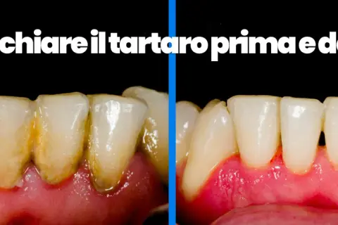 Denti con tartaro prima e dopo la pulizia. Scopri come pulire i denti dal tartaro a casa per un sorriso smagliante.