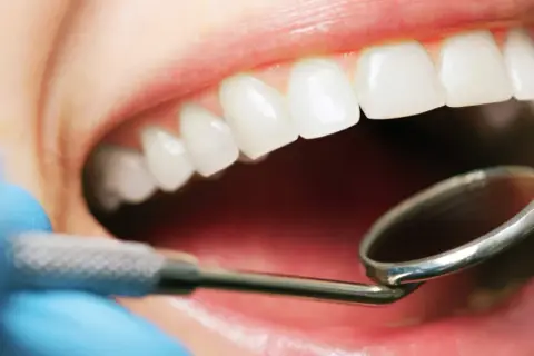 Esame del cavo orale con specchietto dentale. Si osservano denti bianchi e gengive sane, escludendo la presenza di stomatite palato.