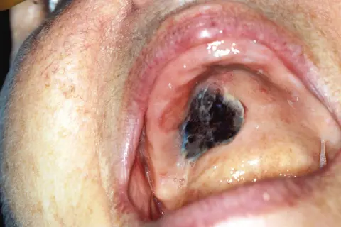 Lesione scura e irregolare sul palato, sospetto melanoma orale.
