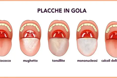 Illustrazione di diverse condizioni della gola, tra cui placche, mughetto e tonsillite, utili per comprendere i rimedi naturali per le placche in gola.