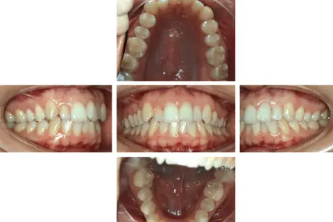 Denti con malocclusione 2 classe, in attesa di trattamento Invisalign.