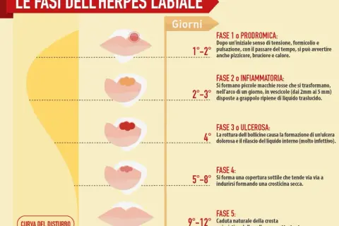 Le fasi dell'herpes labiale: dalla fase prodromica (1-2 giorni) all'ulcera e alla guarigione (fino a 12 giorni).