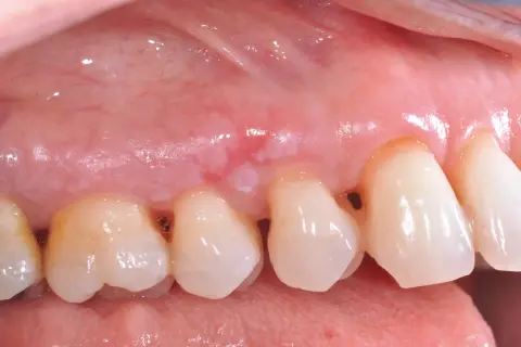 Gengiva con lesione biancastra, possibile leucoplachia villosa, vicino ai denti.
