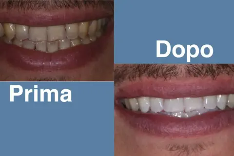 Prima: denti ingialliti con apparecchio fisso trasparente. Dopo: sorriso smagliante con denti bianchi e perfetti.