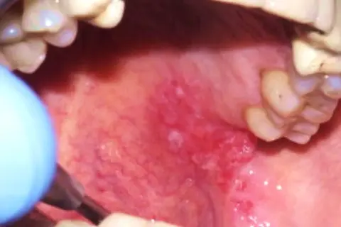 Lingua infiammata con lesioni, strumento medico vicino. La biopsia lingua è dolorosa.