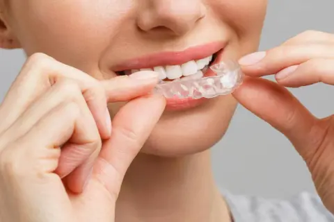 Sorriso smagliante con mascherine denti prima e dopo. La trasparenza delle mascherine invisibili per un sorriso perfetto.