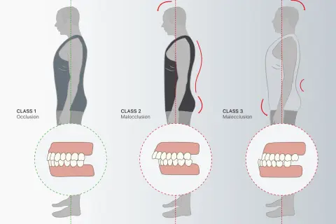 Illustrazione della classificazione di angle: Class 1 (occlusione corretta), Class 2 e Class 3 (malocclusioni) con dettagli dentali.