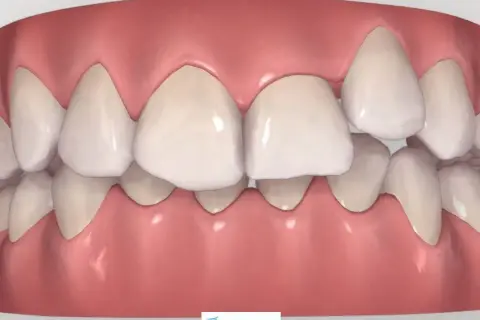 Arcata dentale con un dente storto in evidenza, che necessita di correzione ortodontica per un sorriso perfetto.