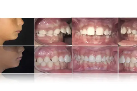 Prima e dopo: correzione di denti a castoro e malocclusioni.