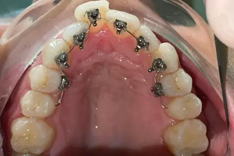 Dettaglio di un apparecchio linguale applicato ai denti superiori, quasi invisibile dall'esterno.