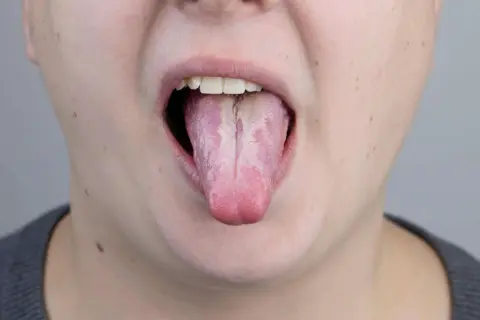 Lingua strana dopo antibiotico, con patina bianca e striature rosate.