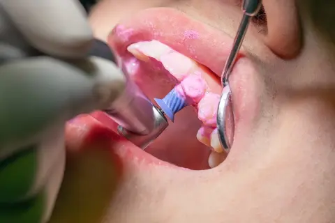 Dettaglio di una pulizia denti professionale con pasta lucidante rosa e uno strumento rotante.