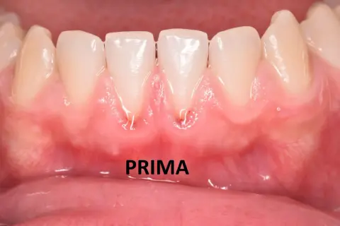 Gengive arrossate e gonfie, con segni di infiammazione, suggeriscono una stomatite gengivale. La parola "PRIMA" indica la situazione iniziale.