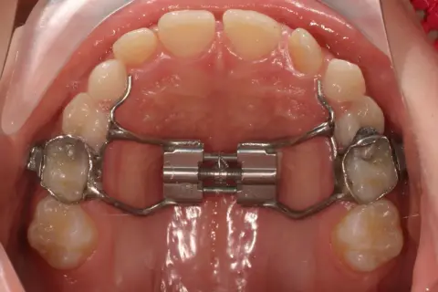 Espansore palatino con bite block ortodonzia. Strumento metallico per allargare il palato, fissato ai denti.