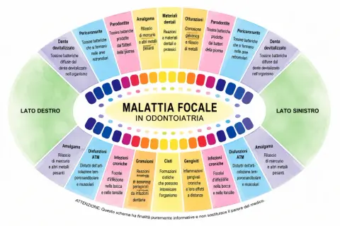 Schema sulla malattia focale in odontoiatria: denti devitalizzati, parodontite, amalgama e altri problemi legati ai **quadranti denti**.