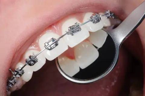 Dettaglio di denti con apparecchio ortodontico metallico. Un piccolo specchietto riflette i denti, mostrando come si mette l'apparecchio.