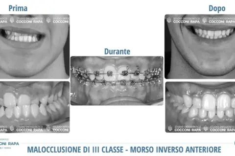 Prima e dopo un trattamento ortodontico per correggere una malocclusione dentale e problemi neurologici correlati.