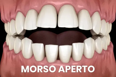 Denti con morso aperto. Si può mettere l'apparecchio anche avendo degli impianti dentali per correggere questa malocclusione.
