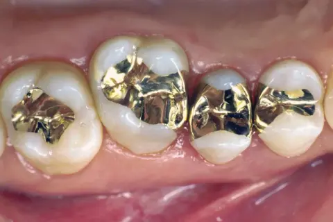 Denti con otturazioni in oro, fase di preparazione intarsio dentale.