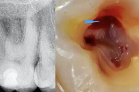 Radiografia e ingrandimento del primo molare superiore con polpa esposta e sanguinante, indicata da una freccia blu.