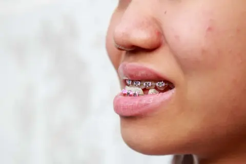 Primo piano di un sorriso con apparecchio ortodontico, inclusi brackets rosa, per correggere un morso inverso.