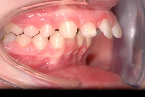 Denti superiori sporgenti e inferiori retratti, un caso di malocclusione 2 classe adulto.