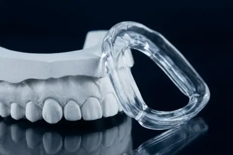 Modello dentale e bite trasparente, soluzione per il bruxismo consigliata dal dentista.