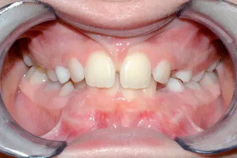 Bocca aperta con denti da latte e il frenulo labiale superiore visibile tra gli incisivi centrali.