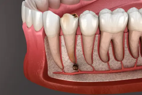 Dente cariato con radice infetta, pronto per l'estrazione. La durata estrazione dente dipende dalla complessità.