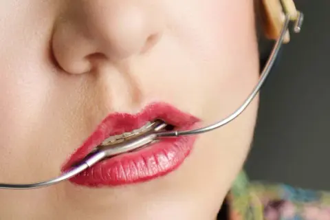 Labbra rosse con apparecchio ortodontico, un dettaglio del viso con un apparecchio baffo che si estende verso l'orecchio.