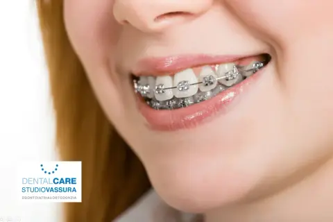 Sorriso con apparecchio ortodontico. L'ortodonzia, il cui significato è allineare i denti, migliora l'estetica e la salute orale.