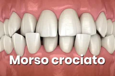 Denti con morso incrociato, una condizione che necessita di correzione ortodontica.