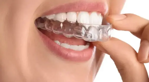 Dita che posizionano un apparecchio di contenzione trasparente sui denti bianchi.