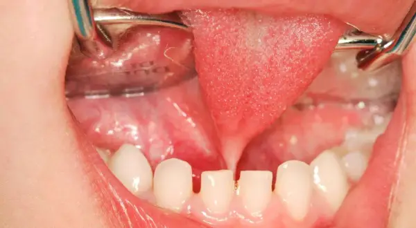Bocca di bambino con lingua retratta da frenulo linguale corto, denti da latte e strumenti dentistici.