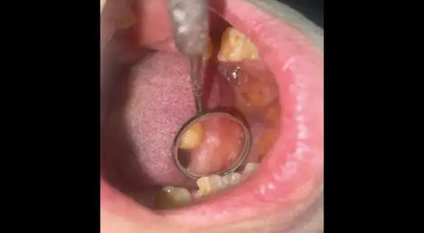 Area bianca sulla guancia interna, possibile leucoplachia. Esame dentistico in corso.