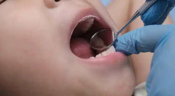 Esame dentistico: un piccolo specchietto riflette la bocca aperta di un bambino, mostrando la lingua e alcuni puntini sul palato.