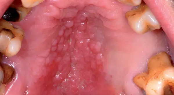 Ingrandimento del palato con un evidente **rilievo sul palato**, caratterizzato da papule e arrossamento.