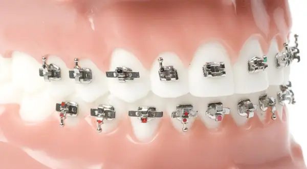 Modello di denti con apparecchio ortodontico, con attacchi metallici e fili che sembrano piccole stelline.
