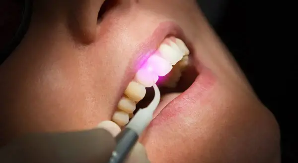 Trattamento dentale con laser. Un raggio rosa illumina un dente, mostrando la precisione della laser dentistry.