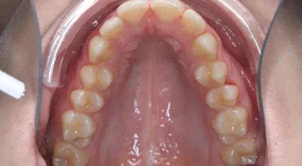 Vista interna della bocca con denti superiori e palato. Si nota un leggero mento retratto, con un divaricatore che espone l'arcata dentale.