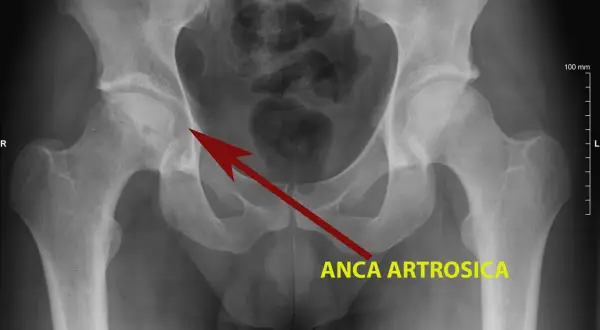 Radiografia del bacino che mostra una rima di radiotrasparenza nell'anca destra, indicata da una freccia rossa e dalla scritta "ANCA ARTROSICA".