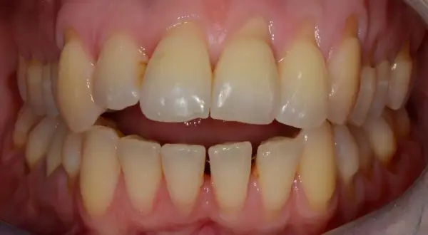 Vista ravvicinata di un morso incrociato laterale in adulti, con denti superiori che coprono quelli inferiori.