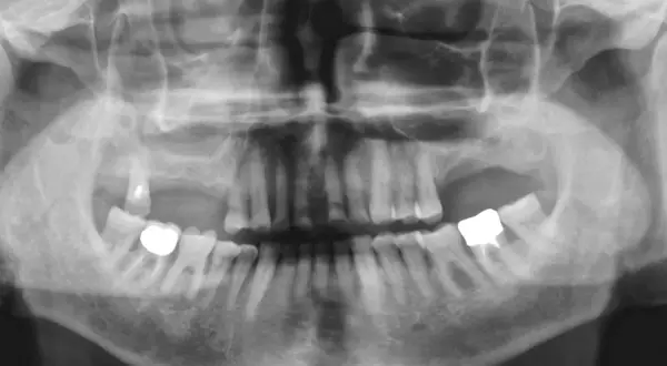 Radiografia panoramica dentale che mostra un'ombra nel seno mascellare, suggerendo una possibile cisti mucosa.