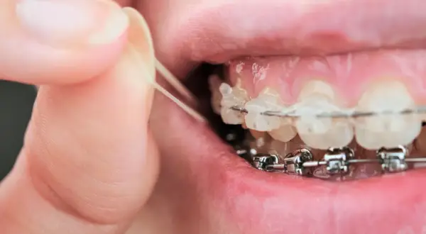 Dita che posizionano elastici sull'apparecchio dentale. A volte gli elastici apparecchio fanno male, ma sono necessari per allineare i denti.