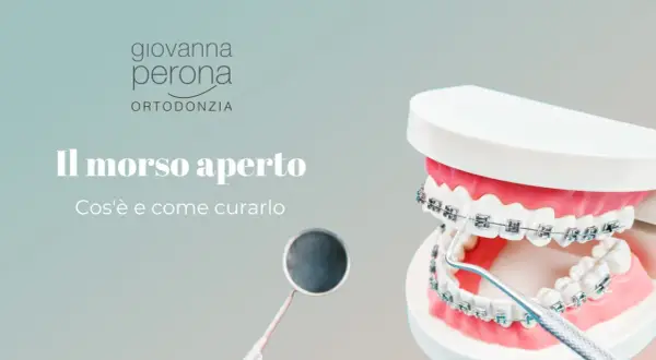 Modello di denti con apparecchio ortodontico mostra un morso aperto. Un dentista esamina il caso.