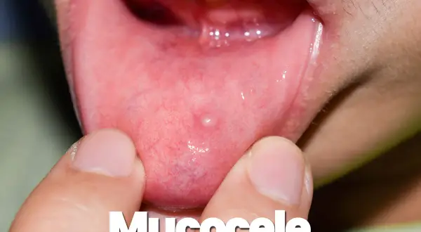 Piccolo mucocele, una cisti da ritenzione, appare sulla mucosa interna della bocca, evidenziata da dita.