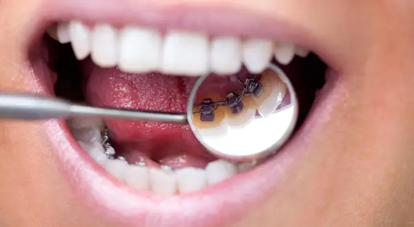 Primo piano di una bocca con apparecchio dentale. Il morso profondo apparecchio è visibile nello specchietto del dentista.